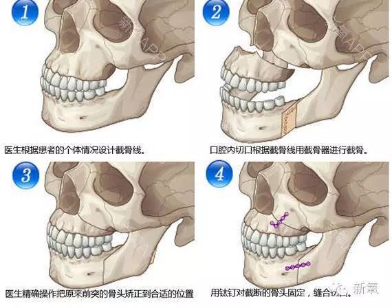 b,上下颌左右第四牙齿拔除,上颌前份截骨 下颌根尖下截骨.