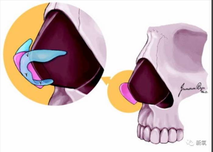 图中的移植物也就是上面提到采取的部分鼻中隔,然后将移植物与鼻翼