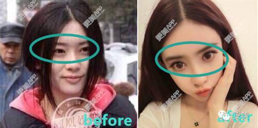 而真正缺乏的是自己的特色和辨识度 以前的单眼皮虽然变成了双眼皮
