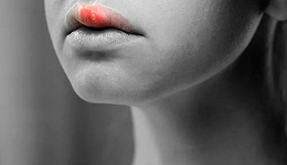 嘴起泡可能是感染了这种“病毒”，一朝感染终身复发