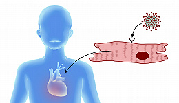 数据 | 新冠病毒和心肌炎有哪些关联？数据告诉你