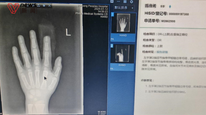 小鹏X9夹断幼童手指，车企称已升级防夹功能
